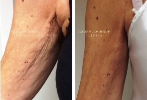 HIFU Skin Tightening - Before and After Treatment