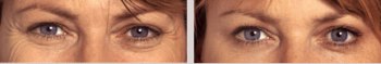 Anti-wrinkle Botox Treatment to Soften Eye Lines & Wrinkles