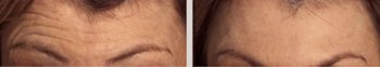 Botox Anti-wrinkle Treatment to Get Rid of Forehead Lines