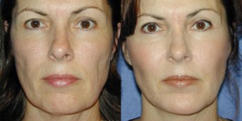 Cheek Augmentation Treatment - Before and After Picture