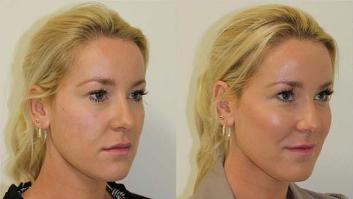 Cheek Enhancement Treatment - Before and After Picture