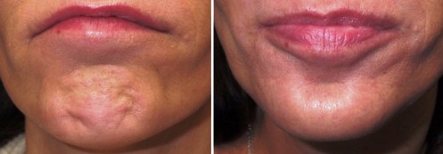 Chin Dimple Removal using - BOTOX - Before and After Picture