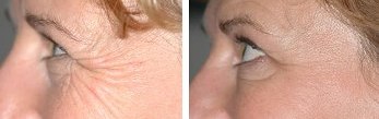 Eye Wrinkles -  Before and After Anti-wrinkle Treatment