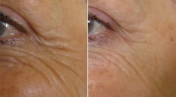 Softening of Eye Lines using BOTOX -  Before and After
