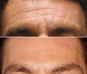 Forehead Lines Men - Botox Treatment - Before and After 