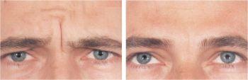 Glabella Lines Men - Botox Treatment - Before and After 
