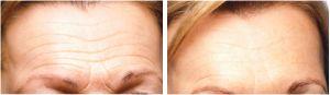 Dermal Filler for Frown Lines - Before and After