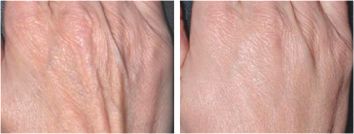 Hand Wrinkles - Before & After Treatment