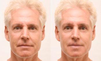 Juvéderm Dermal Filler Treatment for Men