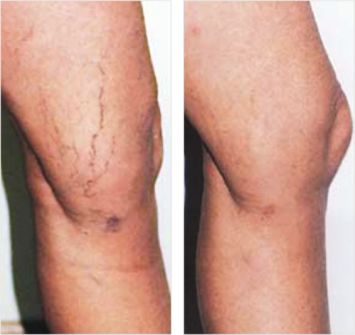 Leg Thread Veins - Before and After