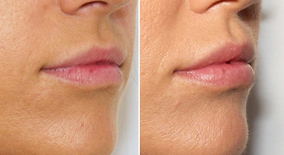 Lip Fillers - Before and After