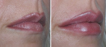 Lip Fillers - Before and After Picture
