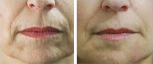 best treatment for wrinkles above lips)