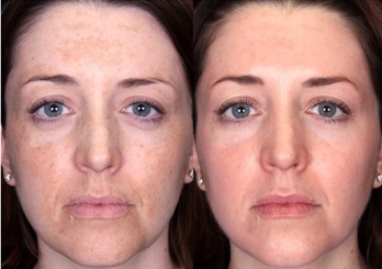 Melasma Treatment Before and After Glycolic Chemical Peel