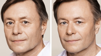 Before and After Eye Line | Crows Feet Treatment - Men