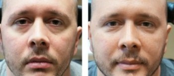 Tear Trough Treatment Men - Dermal Filler Treatment - Before and After 