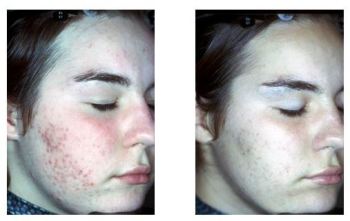 Before and After Glycolic Chemical Peel Treatment