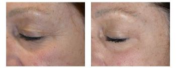 Before and After Eye Wrinkle Treatment