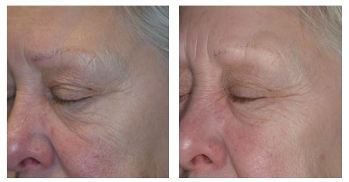 Before and After Chemical Skin Peel Treatments