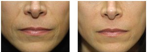 Nose to Mouth Lines - Before and After