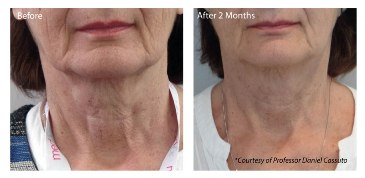 Profhilo - Neck Before and After Treatment