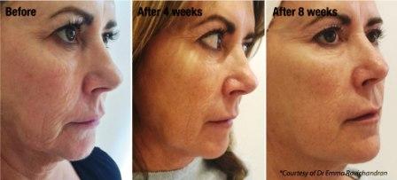 Profhilo - Face Before and After Treatment