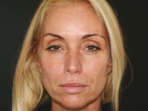 Radiesse dermal filler - Before Photo