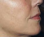 Sculptra After dermal filler Treatment