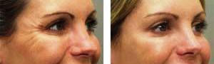 Crows Feet - Before and After Botox Treatment