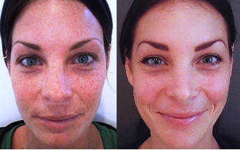 Chemical Peel - Face Before and After Treatment