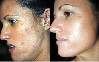 Before and After Chemical Peel Treatment