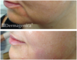 Thread Lift Treatment - Before and After - Marionette Lines