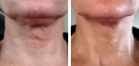 Neck Lift - Before and After PDO Thread Lift Treatment 