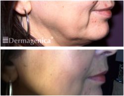 Marionette Lines - Before and After Thread Lift Treatment