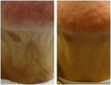 Neck Thread Lift Treatment - Before and After